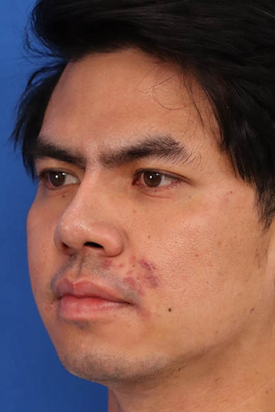 Rhinoplasty For Men case #5265