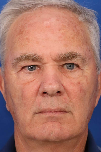 Blepharoplasty case #5278