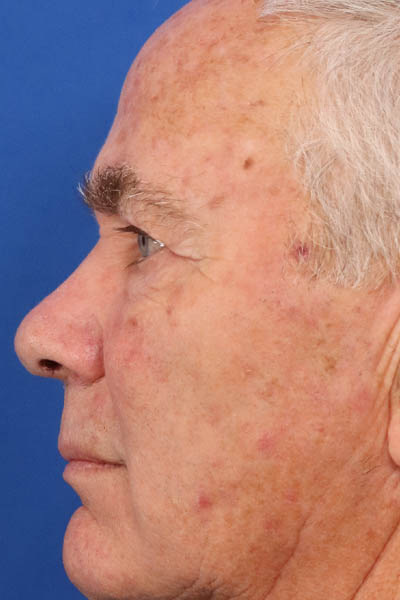 Blepharoplasty case #5278