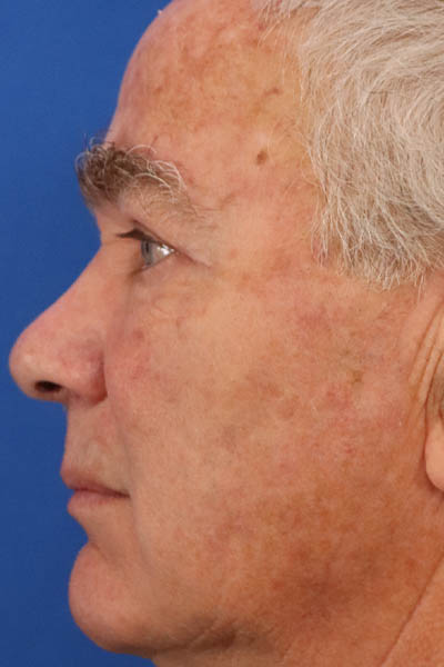 Blepharoplasty case #5278
