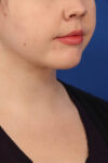 Neck Liposuction case #5152