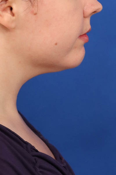 Neck Liposuction case #5152