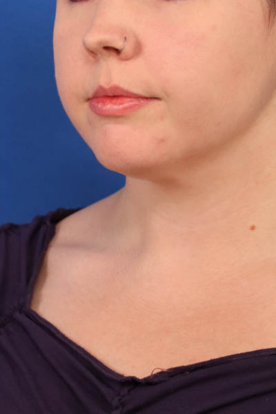 Neck Liposuction case #5152