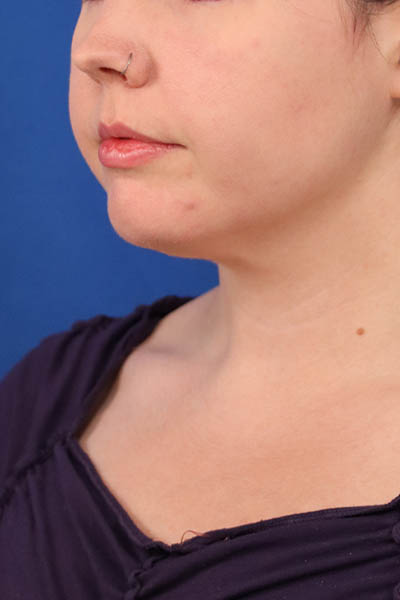 Neck Liposuction case #5152