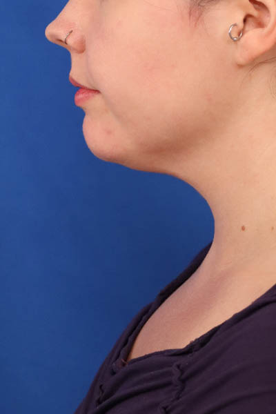 Neck Liposuction case #5152
