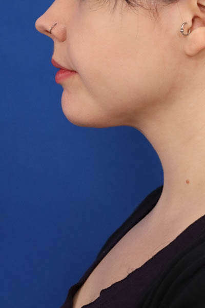 Neck Liposuction case #5152