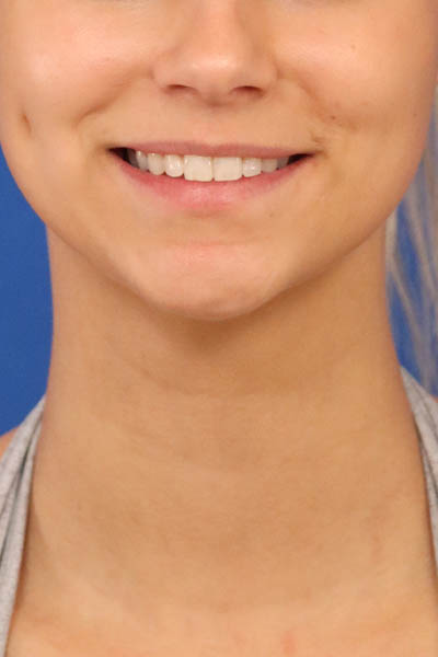 Neck Liposuction case #5176