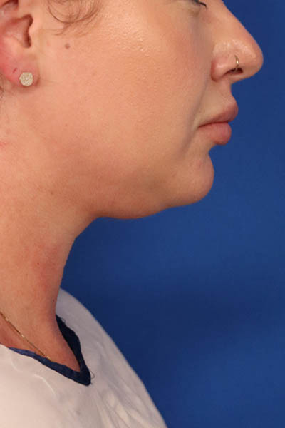 Neck Liposuction case #5213