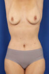 Abdominoplasty case #5224