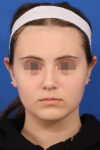 Otoplasty case #5246