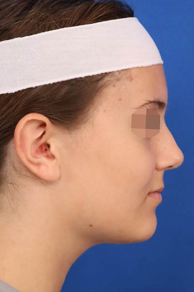 Otoplasty case #5246