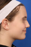 Otoplasty case #5246