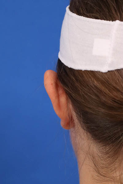 Otoplasty case #5246