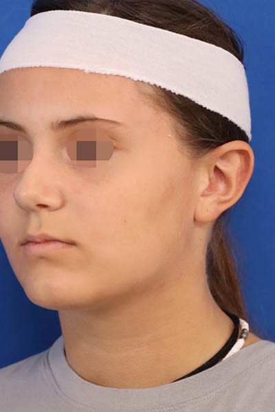 Otoplasty case #5246
