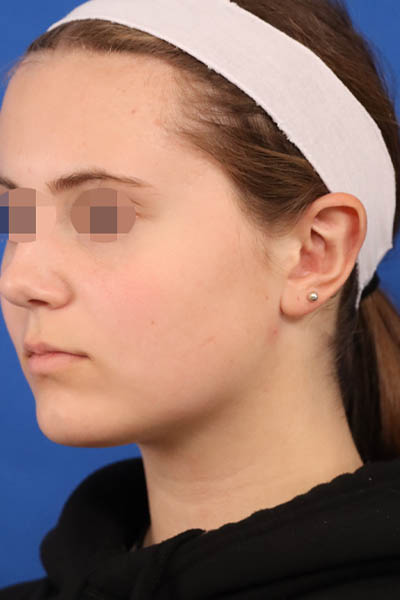 Otoplasty case #5246