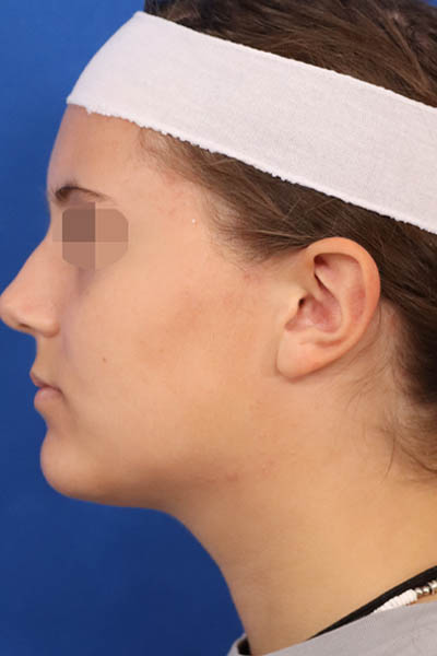 Otoplasty case #5246