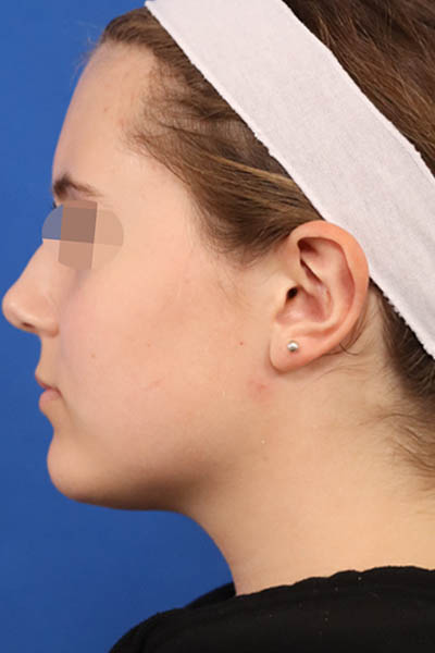 Otoplasty case #5246
