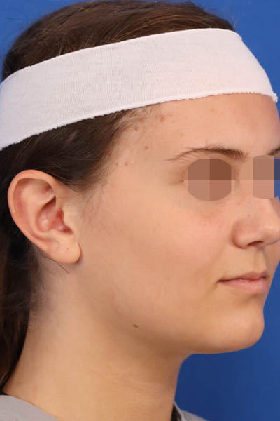 Otoplasty case #5246