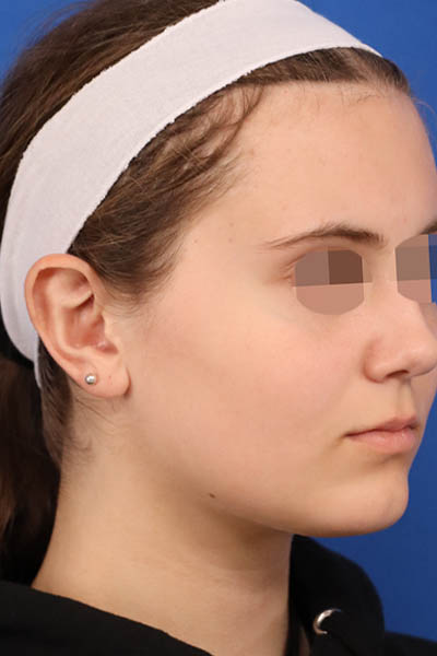 Otoplasty case #5246