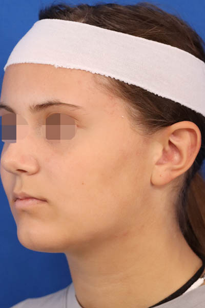 Otoplasty case #5246
