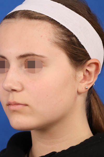 Otoplasty case #5246
