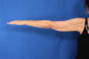 Arm Lift case #5503