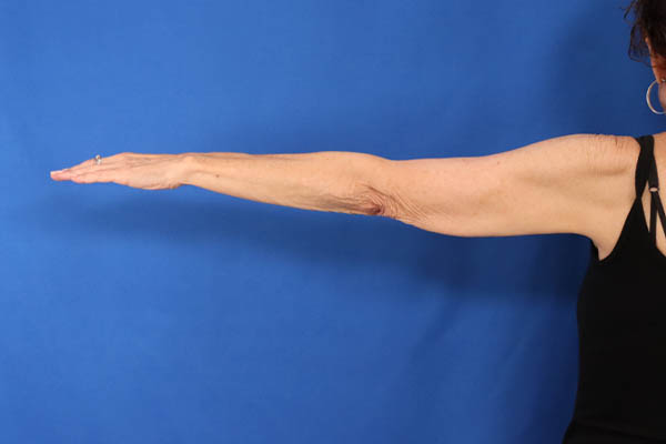 Arm Lift case #5503