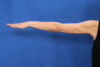 Arm Lift case #5503