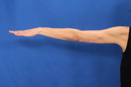 Arm Lift case #5503