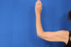 Arm Lift case #5503