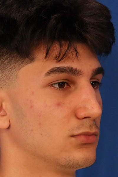 Rhinoplasty For Men case #5549