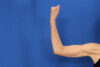Arm Lift case #5503