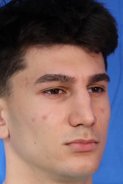 Rhinoplasty For Men case #5549