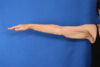 Arm Lift case #5503