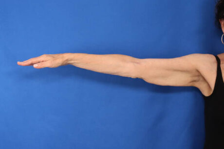 Arm Lift case #5503