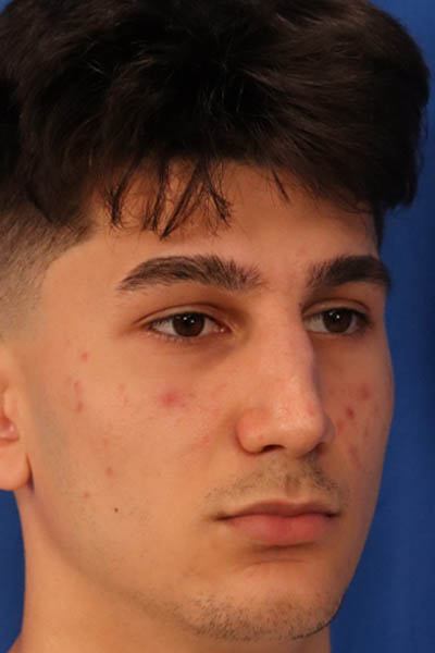 Rhinoplasty For Men case #5549