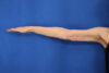 Arm Lift case #5503