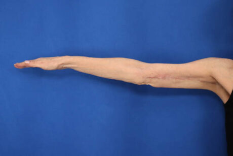 Arm Lift case #5503