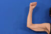 Arm Lift case #5503