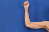 Arm Lift case #5503