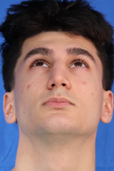 Rhinoplasty For Men case #5549