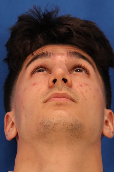 Rhinoplasty For Men case #5549