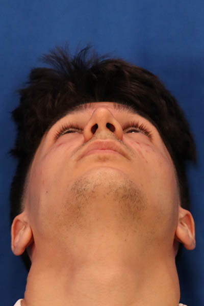 Rhinoplasty For Men case #5549