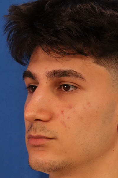 Rhinoplasty For Men case #5549