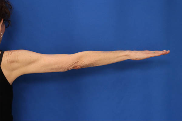 Arm Lift case #5503