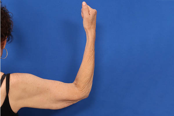 Arm Lift case #5503