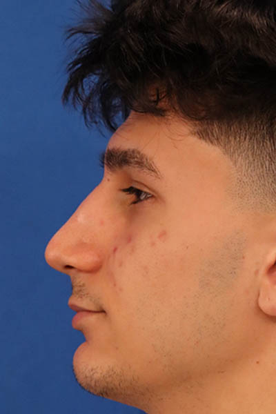 Rhinoplasty For Men case #5549