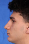 Rhinoplasty For Men case #5549