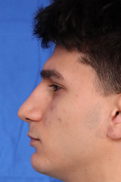 Rhinoplasty For Men case #5549