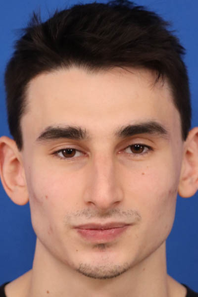 Rhinoplasty For Men case #5568